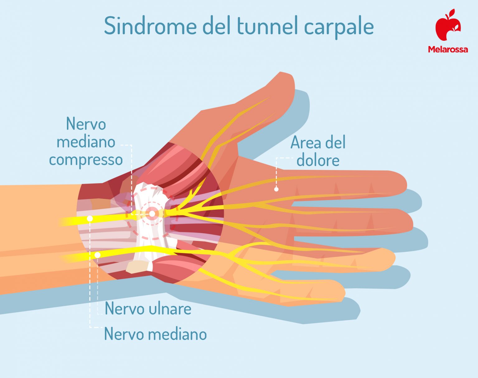 Sindrome del tunnel carpale sintomi, rimedi ed esercizi