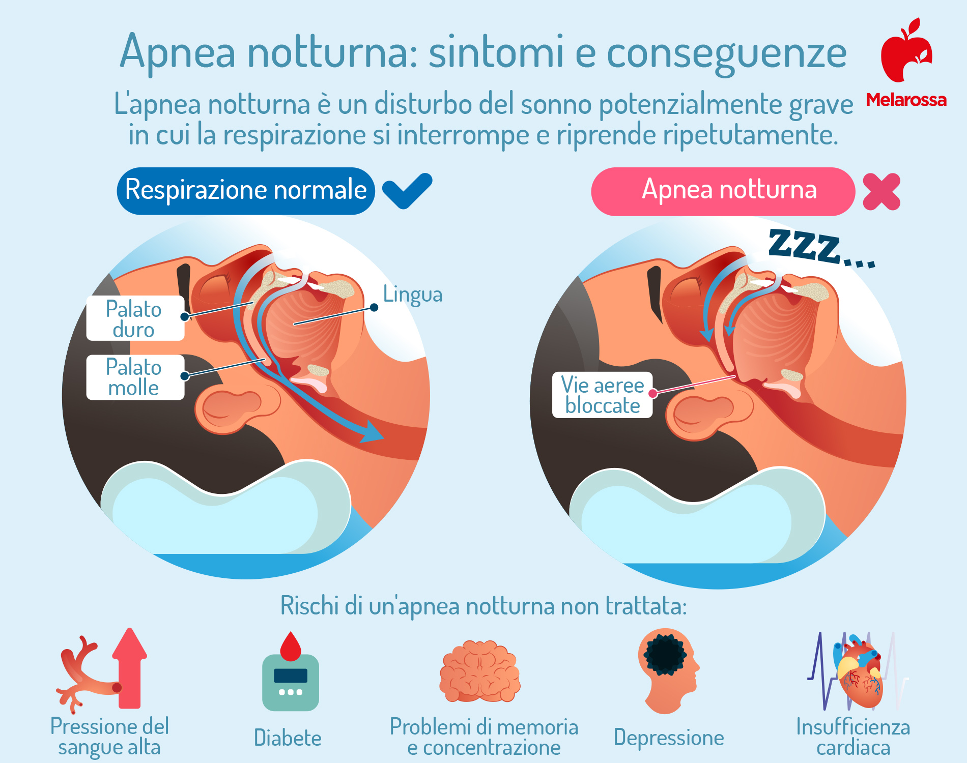 apnea notturna: sintomi e conseguenze