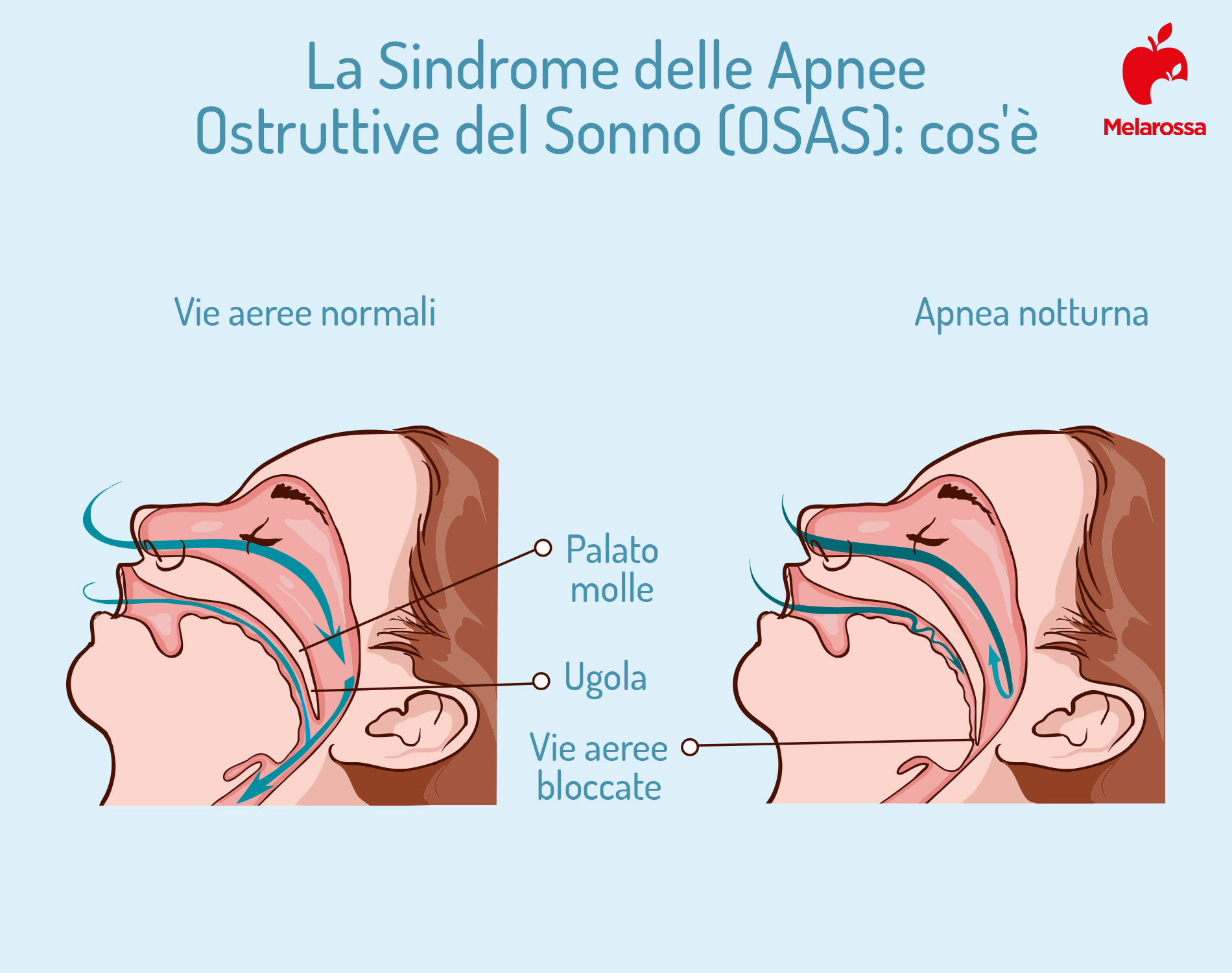 apnea notturna: cos'è