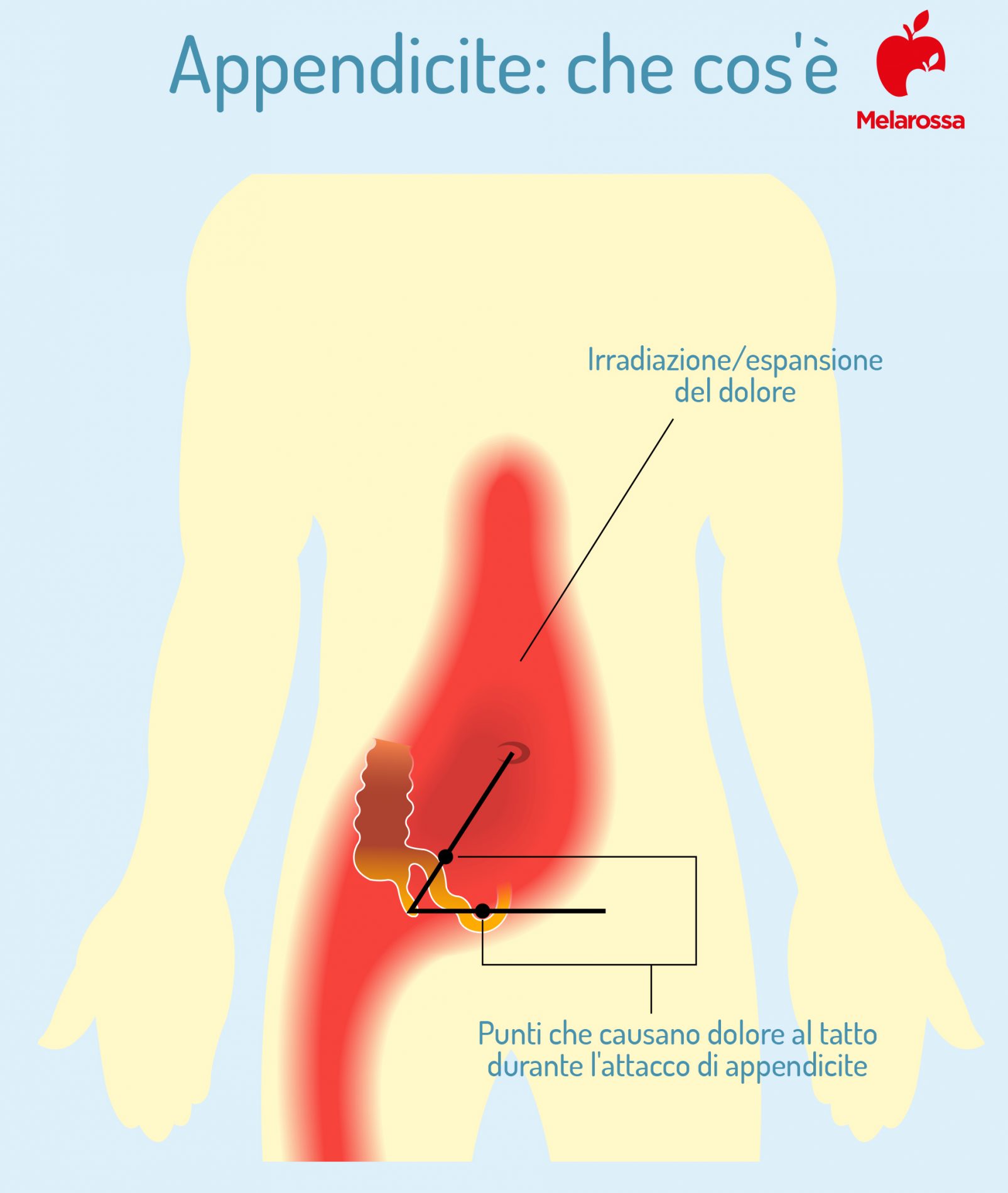 appendicite: cos'è 
