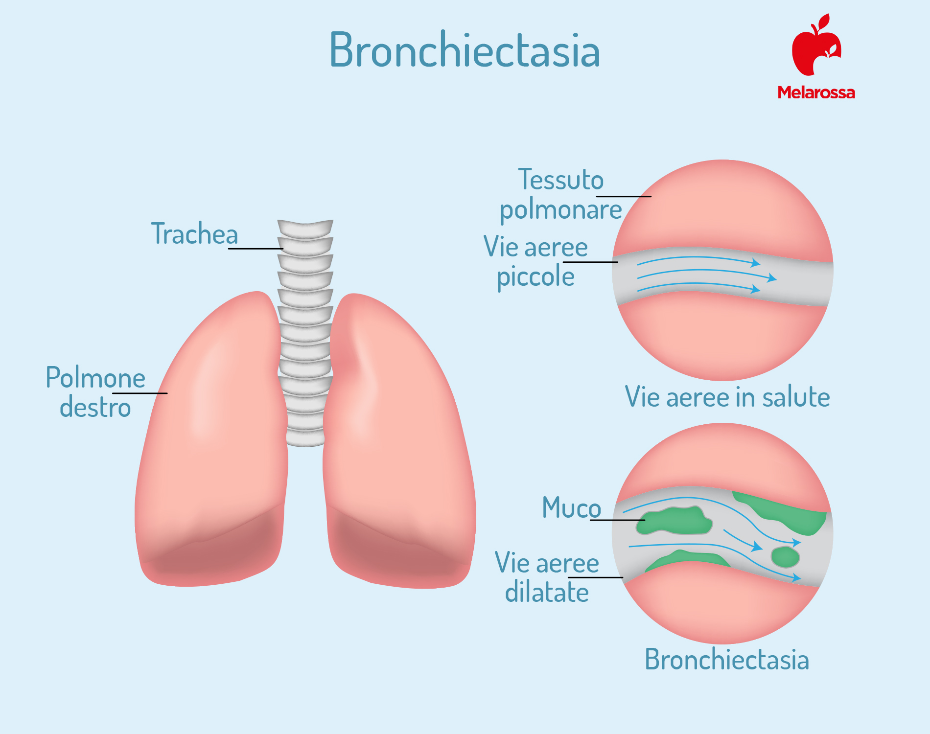 bronchiectasie: cosa sono