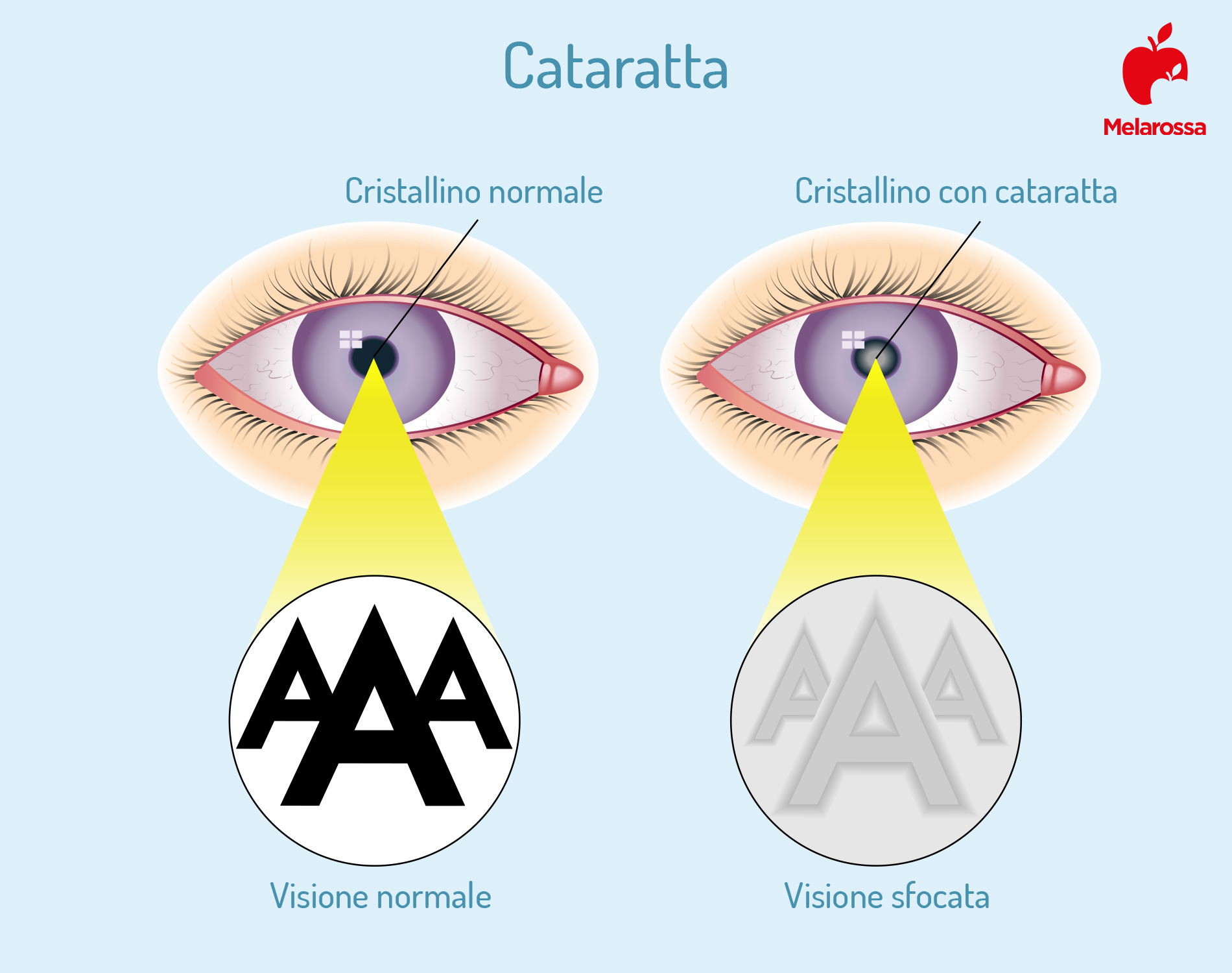 cataratta: cosa succede all'occhio 