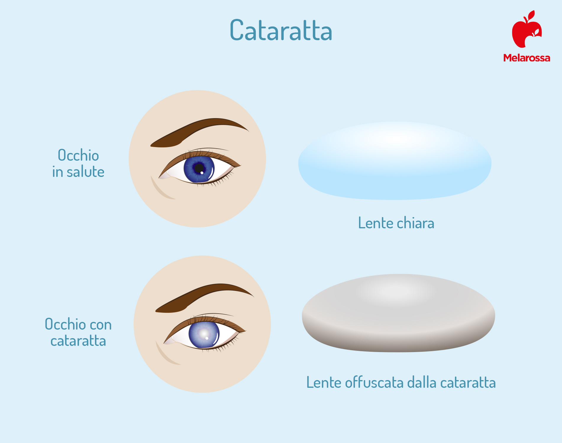 cataratta: sintomi