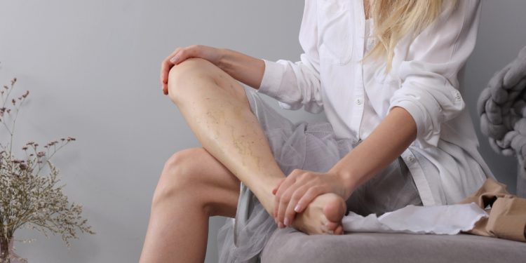 gambe gonfie: cause, sintomi , rimedi, esercizi e quando rivolgersi al medico