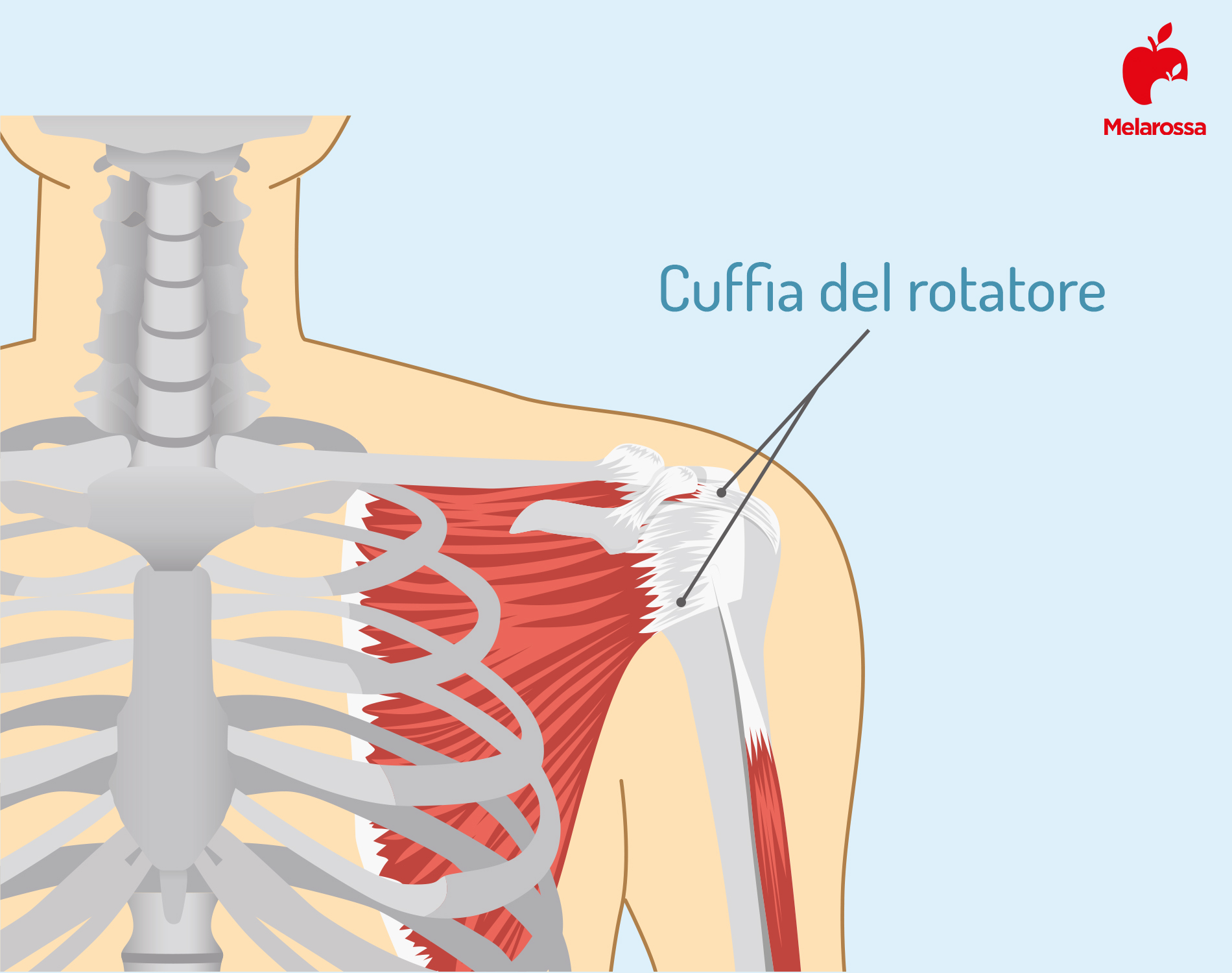 tendinite: rotatore della cuffia