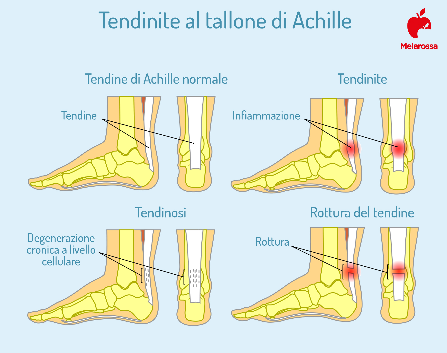 tendinite al tallone di Achille: cause e sintomi