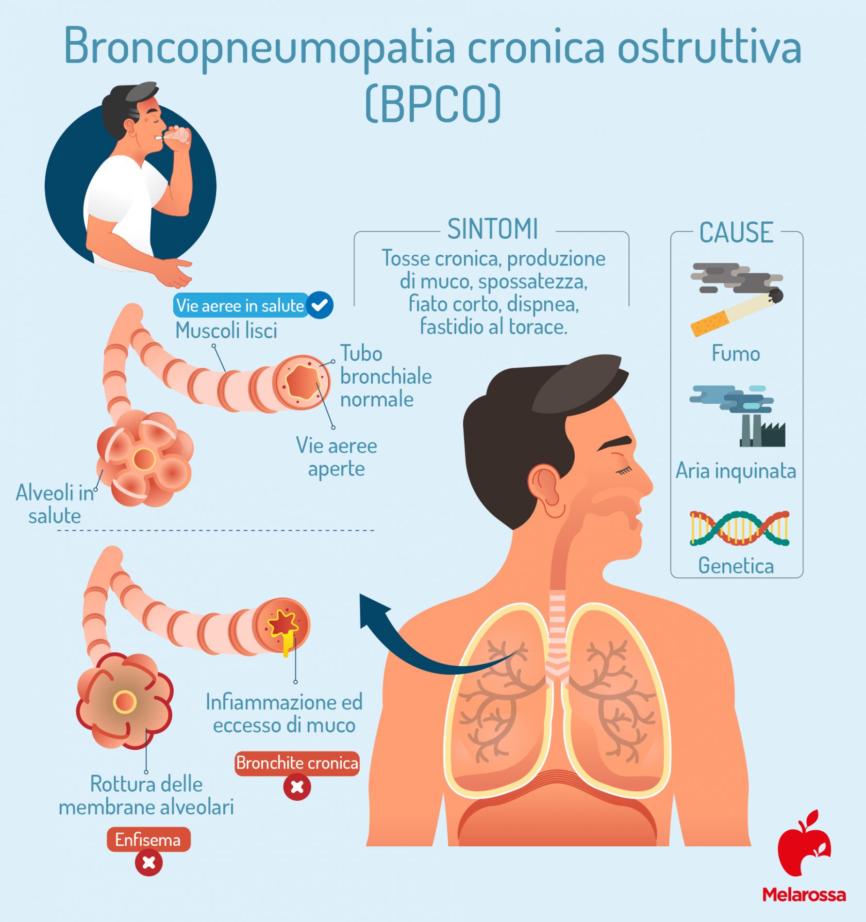 Broncopneumopatia cronica ostruttiva: cause e sintomi 