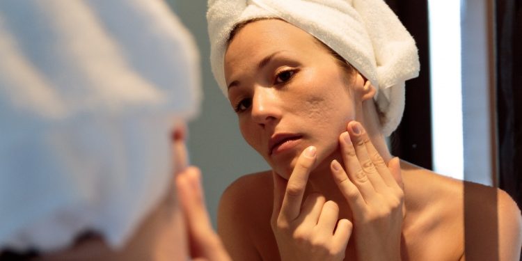 acne: cos'è, tipi, cause, sintomi, cure e trattamenti