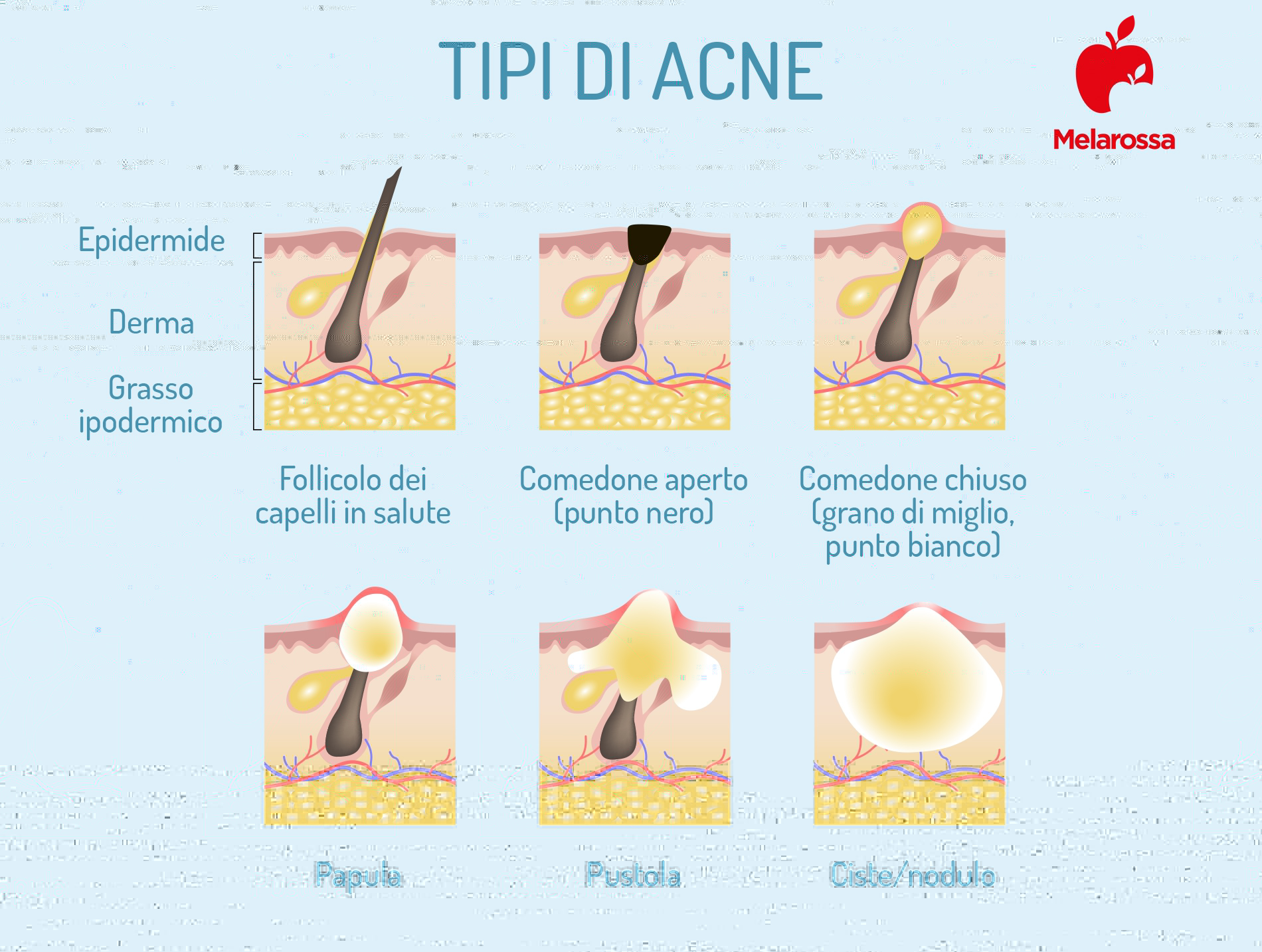 acne: tipi 