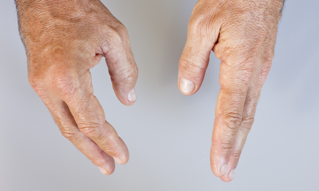 artrite psoriasica: dattilite