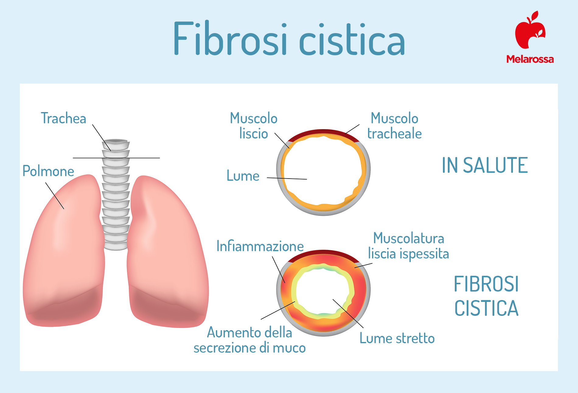 fibrosi cistica: che cos'è 