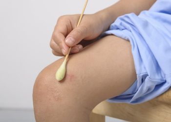 orticaria: cos'è, cause, sintomi e cure