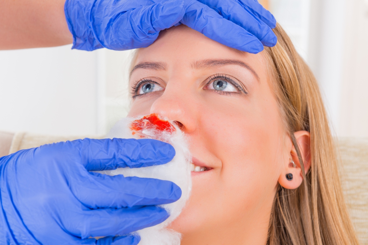 sangue dal naso: cure e trattamenti