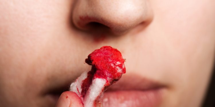 Sangue dal naso o epistassi: cos'è, cause, sintomi e cure