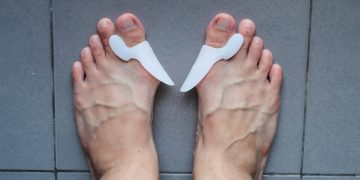 alluce valgo: cos'è, cause, sintomi e cure