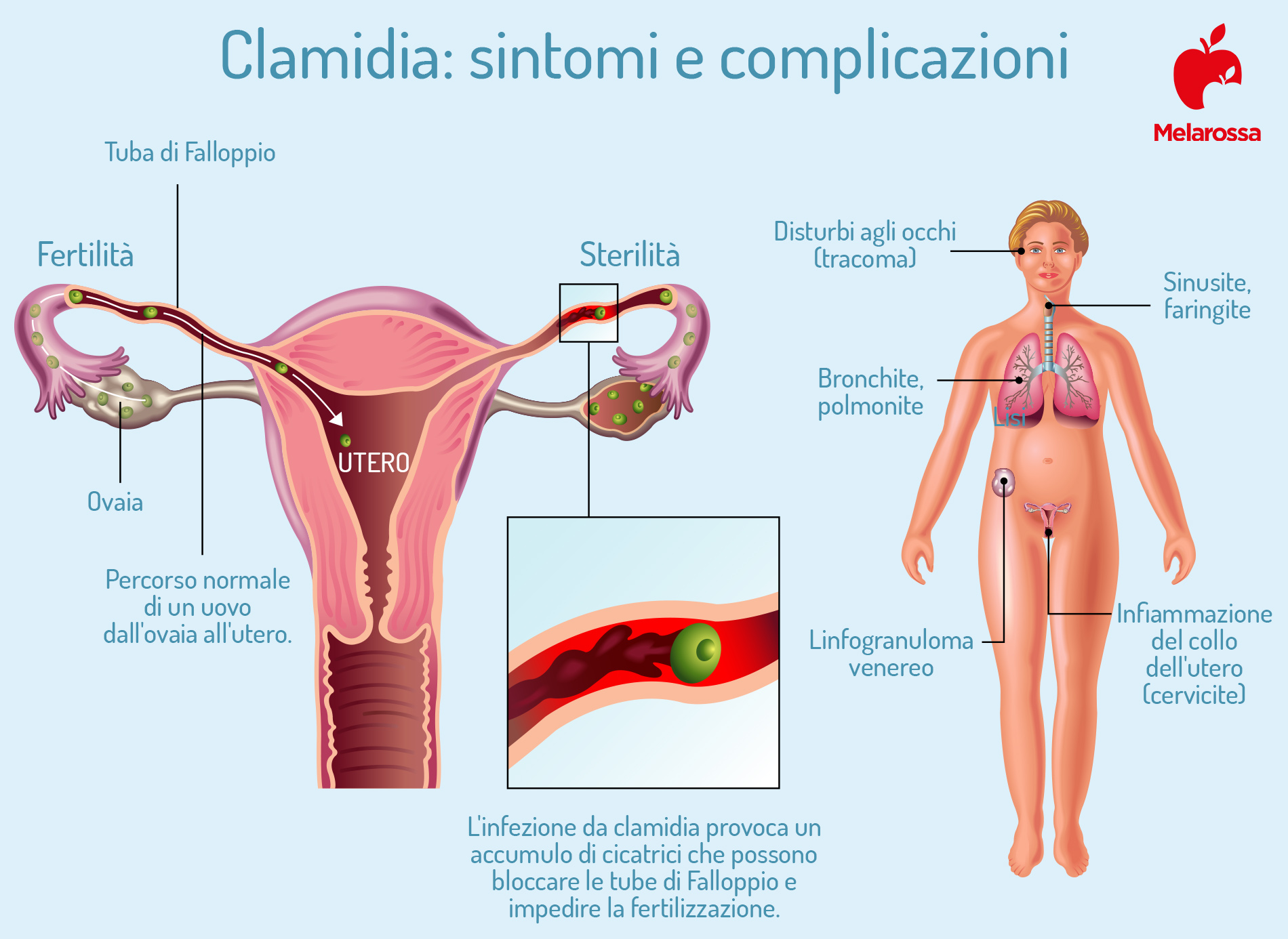 clamidia: sintomi 