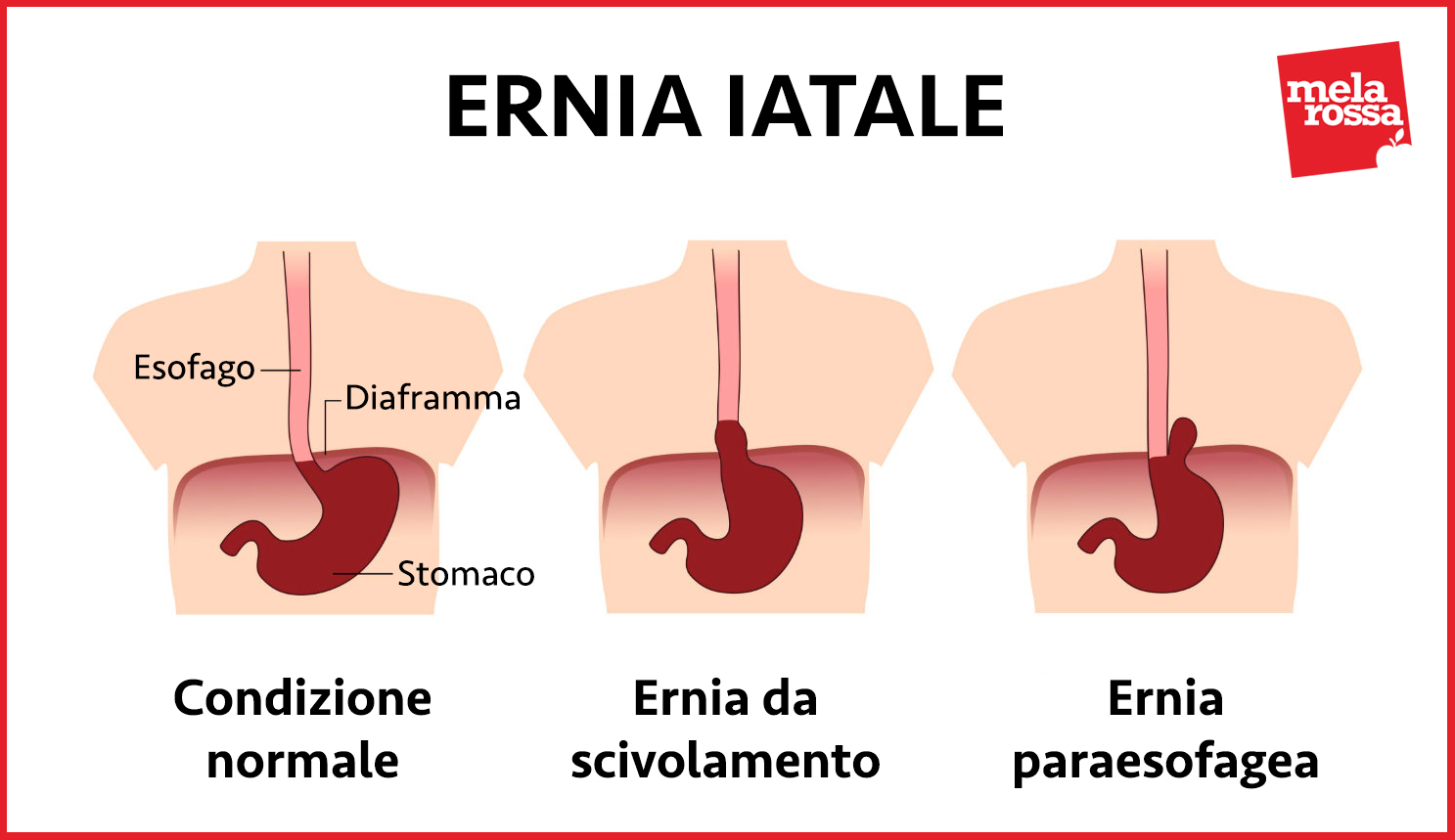 diaframma e malattie