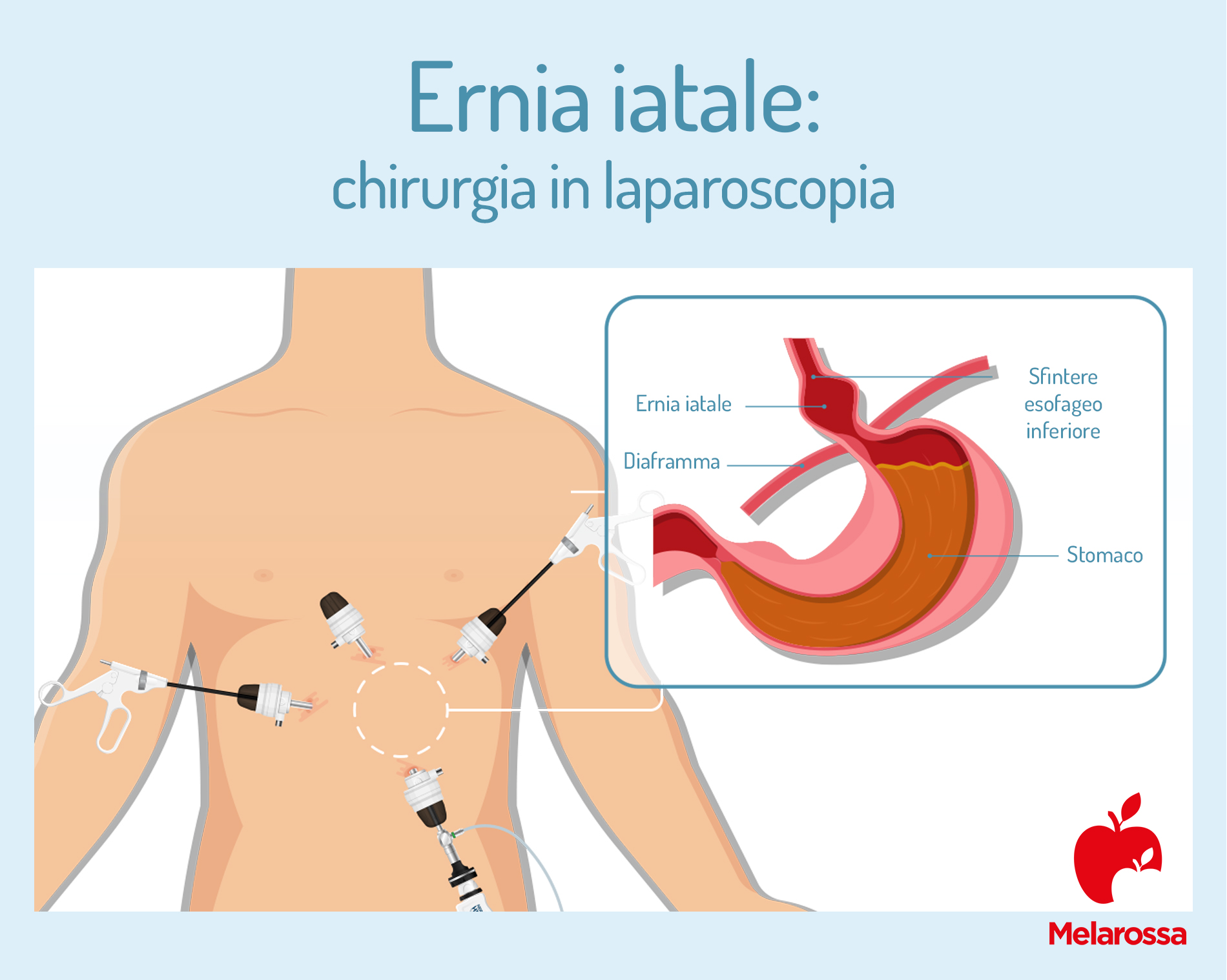 Ernia iatale: chirurgia in laparoscopia