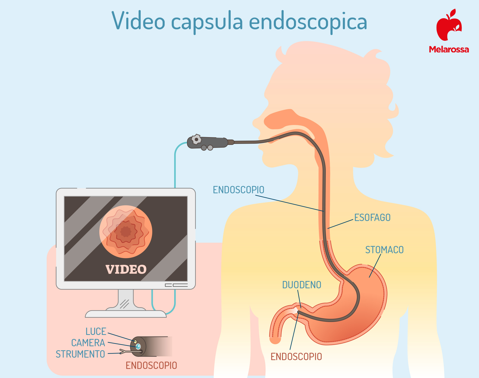 gastroscopia: video capsula endoscopia