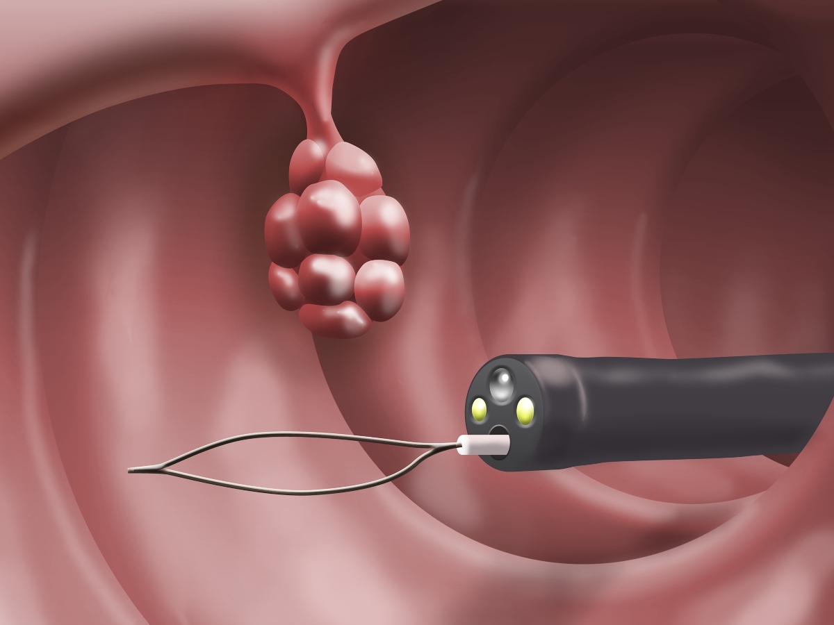 gastroscopia: rimozione polipi