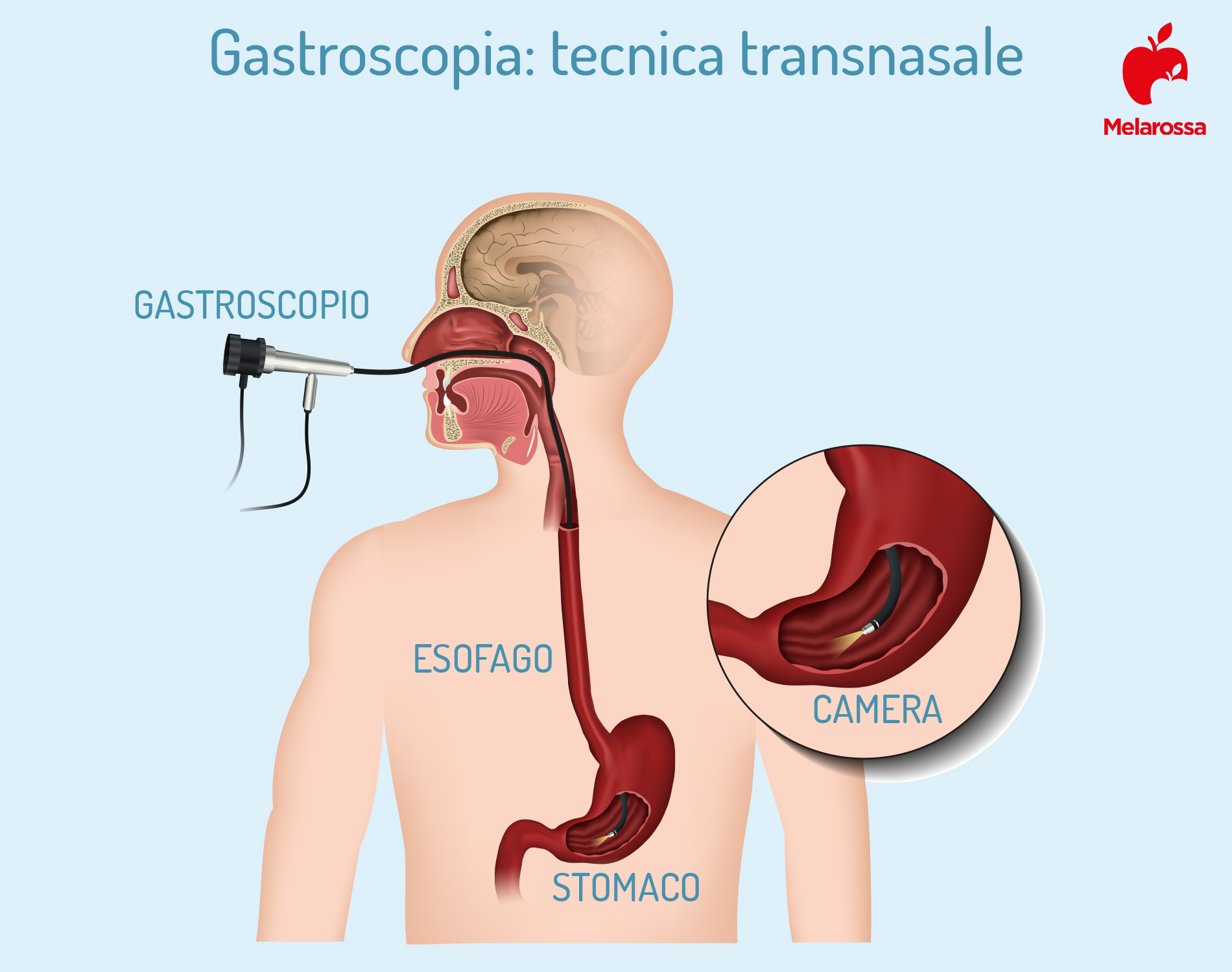 gatsroscopia: tecnica transnasale