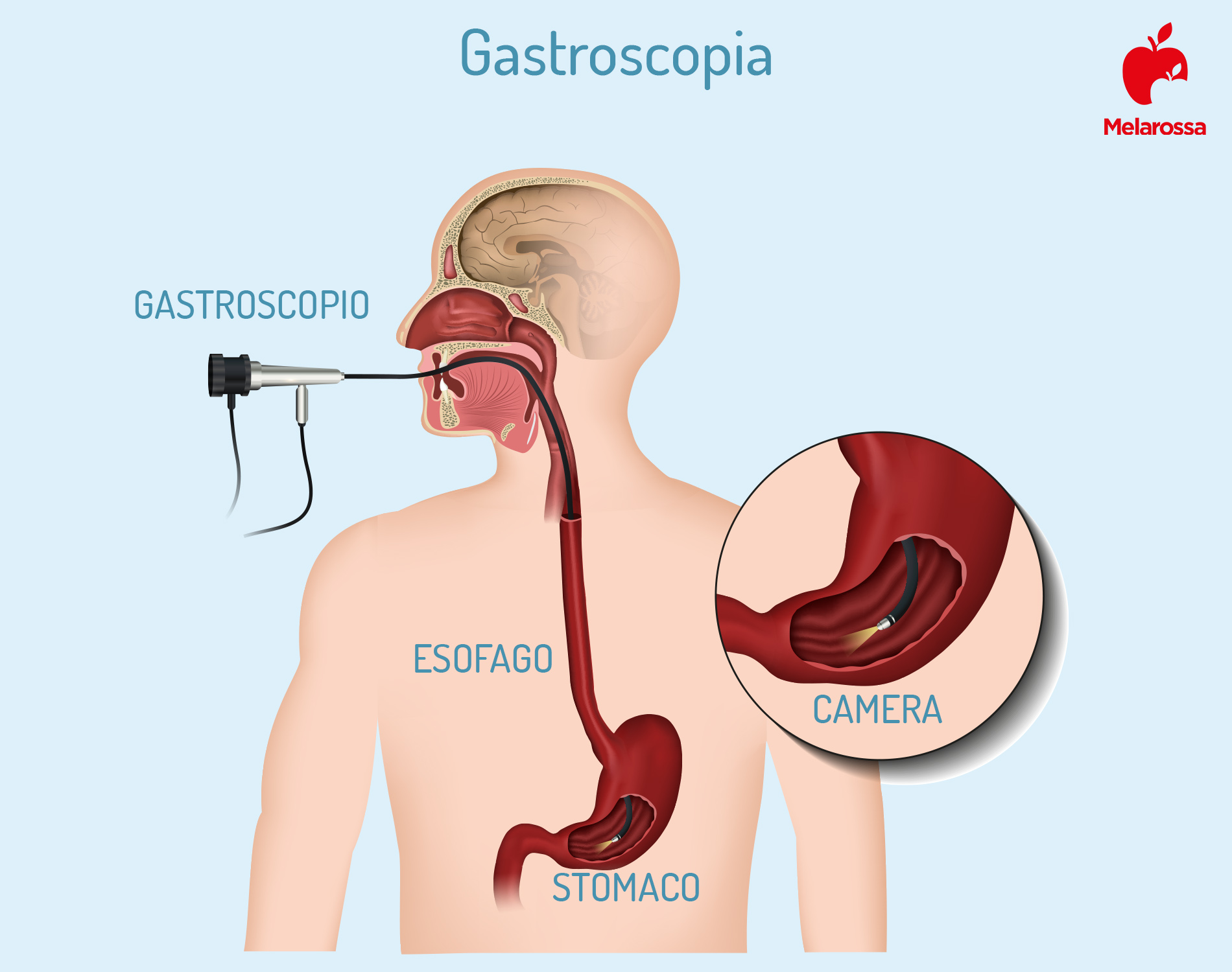 gastroscopia: che cos'è