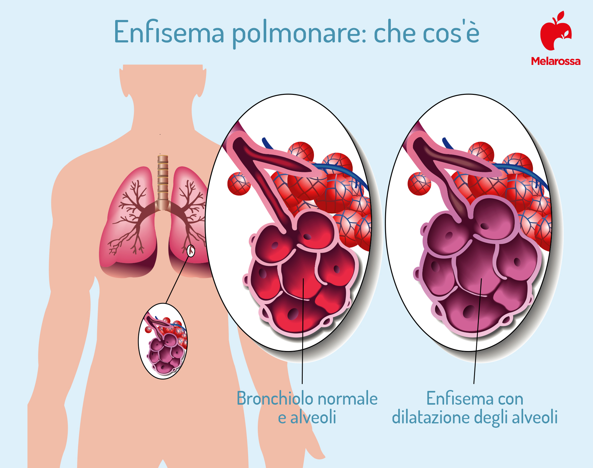 malattie respiratorie: enfisema polmonare