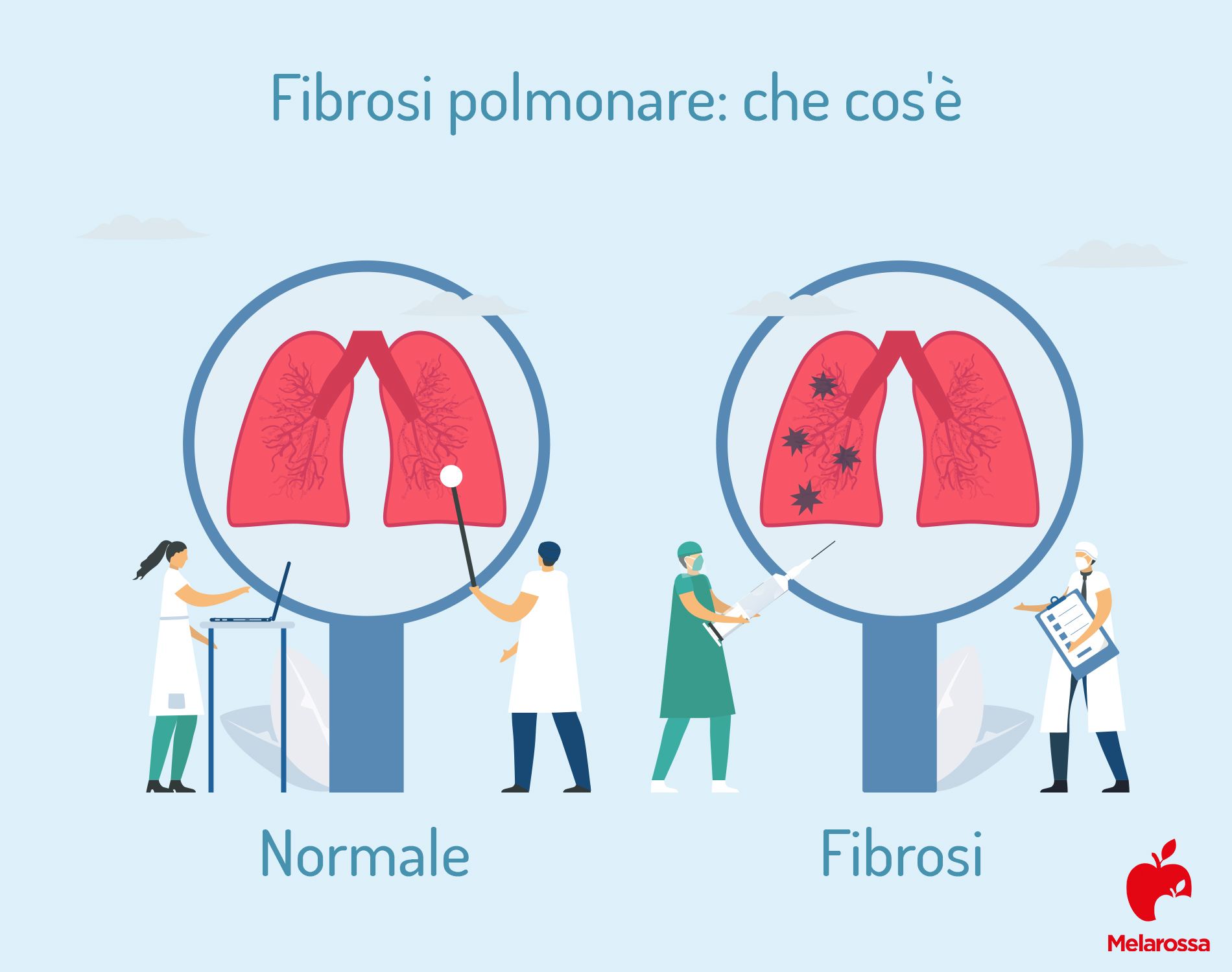 malattie respiratorie: fibrosi polmonare 