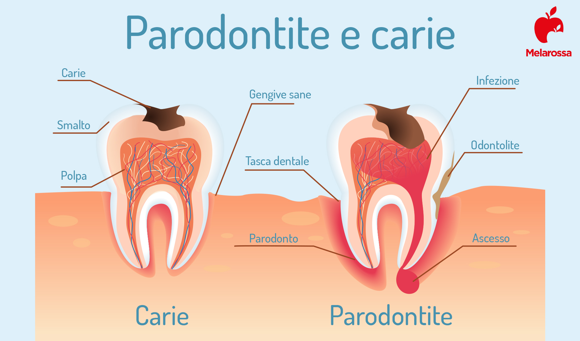 parodontite: cos'è