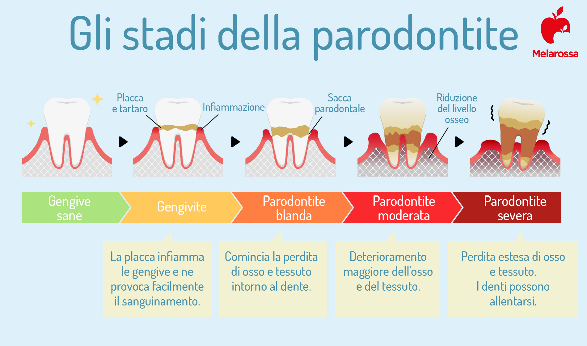 stadi della parodontite 