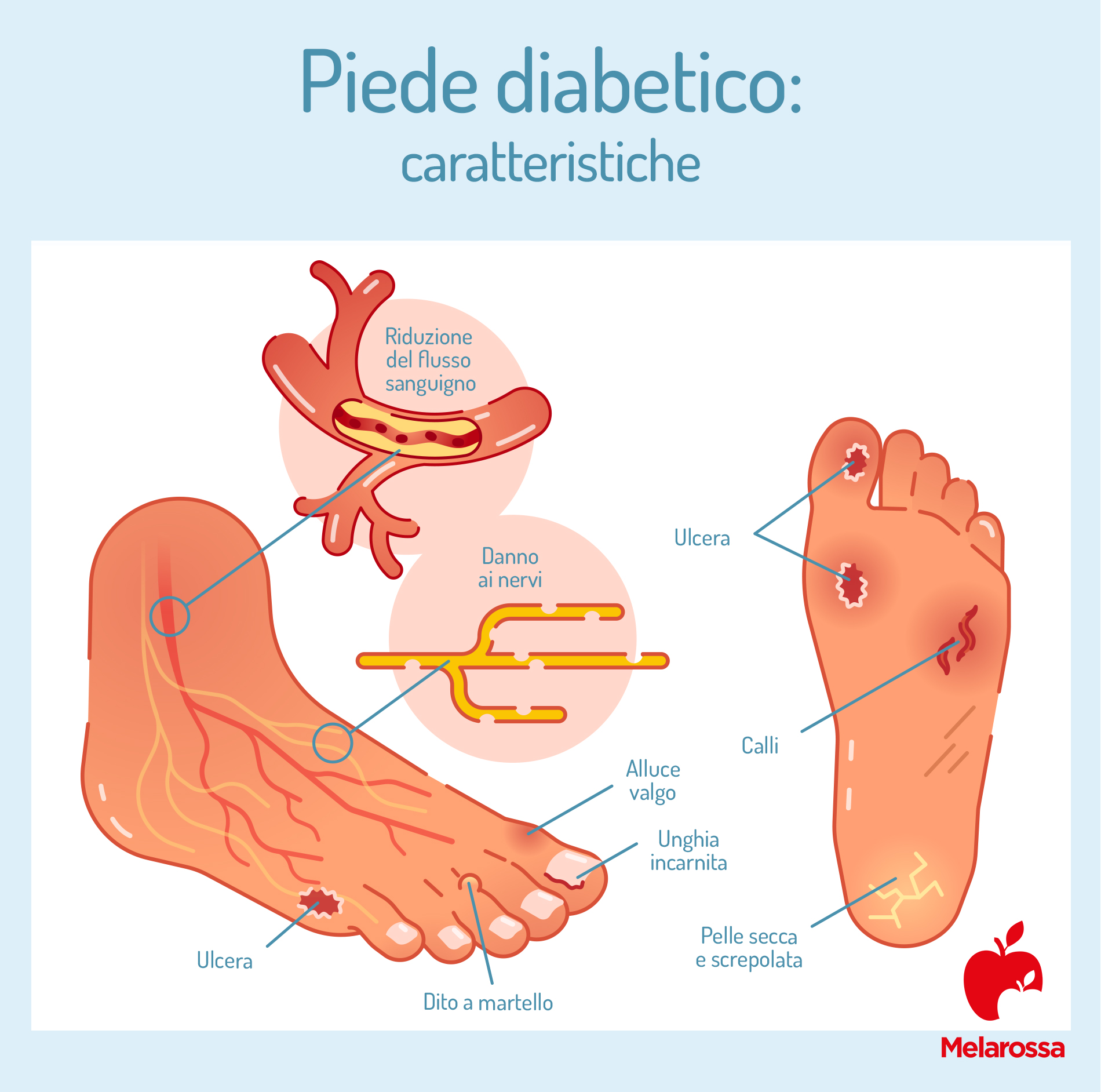 caratteristiche del piede diabetico