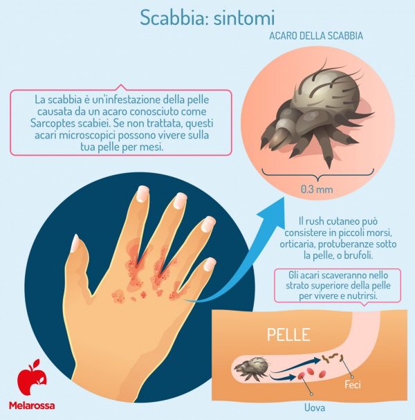 Scabbia: cos’è, come si trasmette, sintomi, diagnosi, cure e prevenzione
