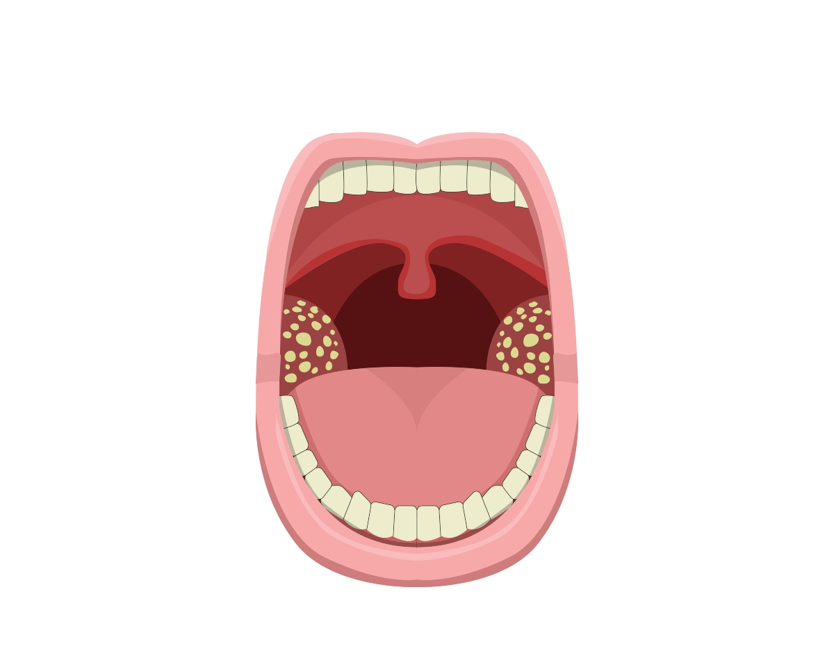 tonsille infette: come sono 