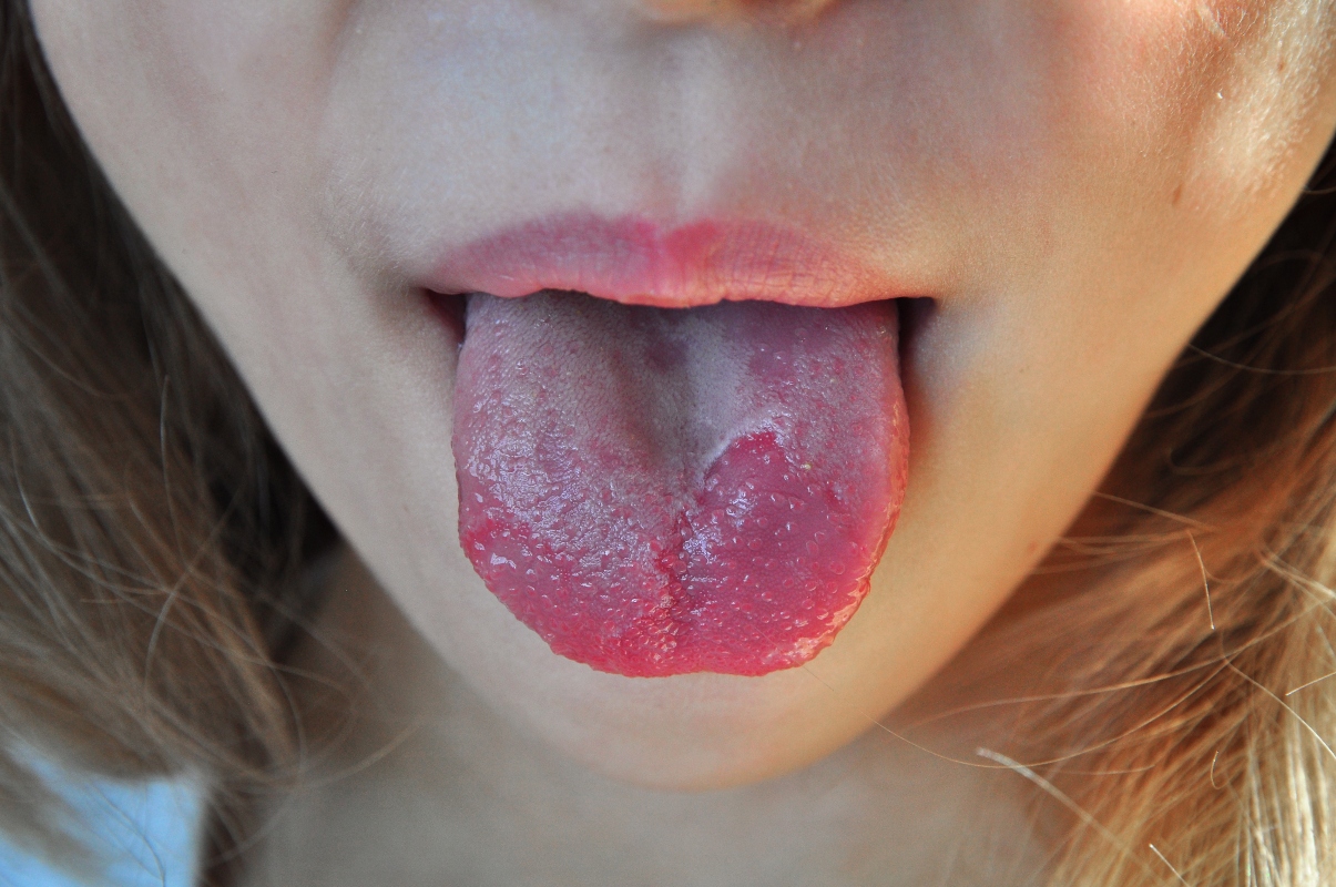 tonsillite: possibili cause