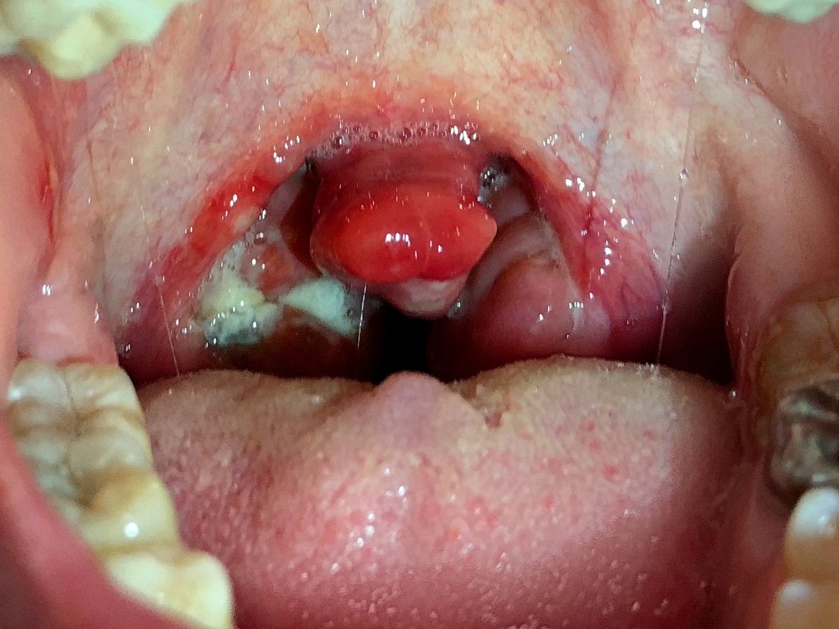 tonsillite: immagini 