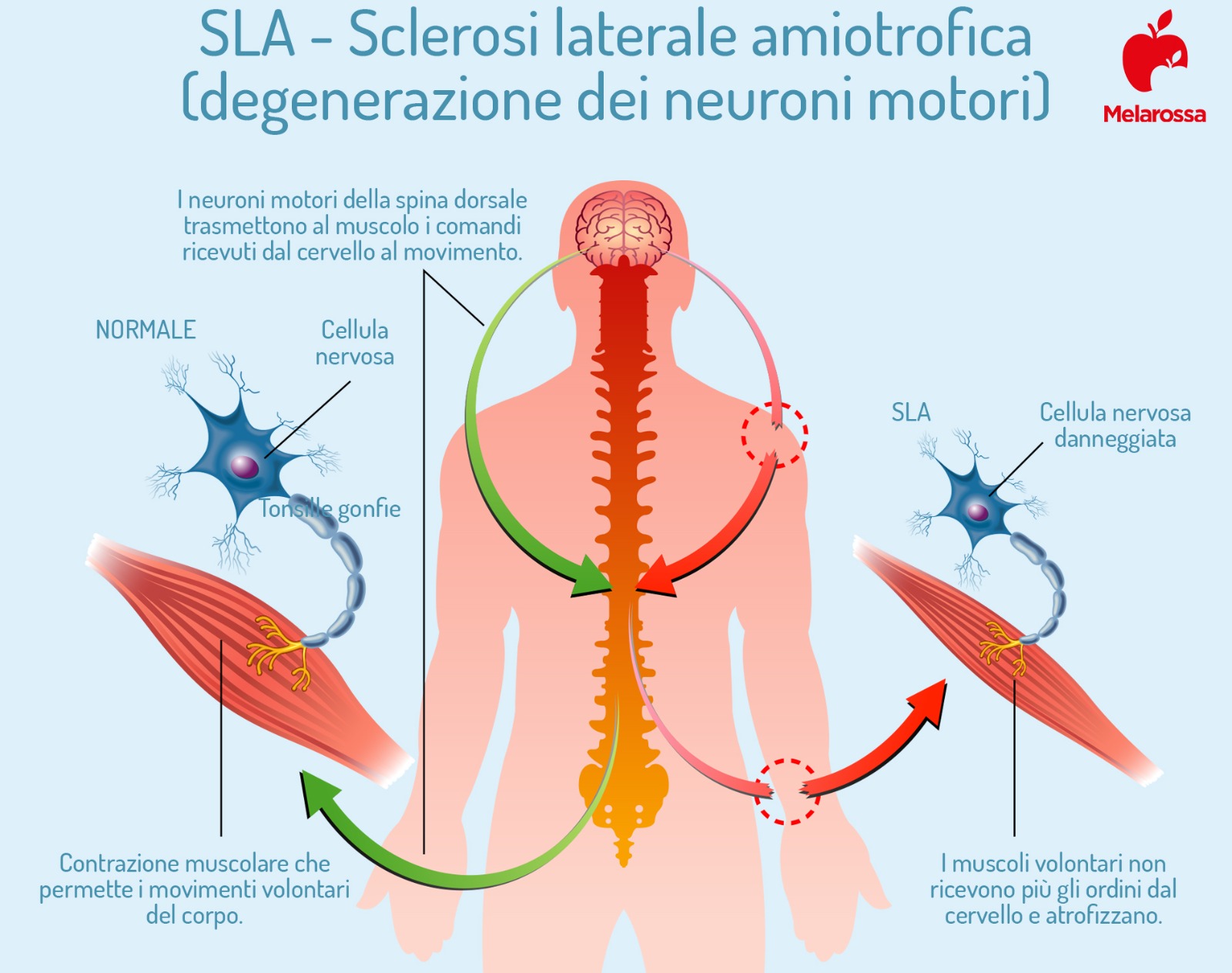 SLA degenerazione neuroni motori