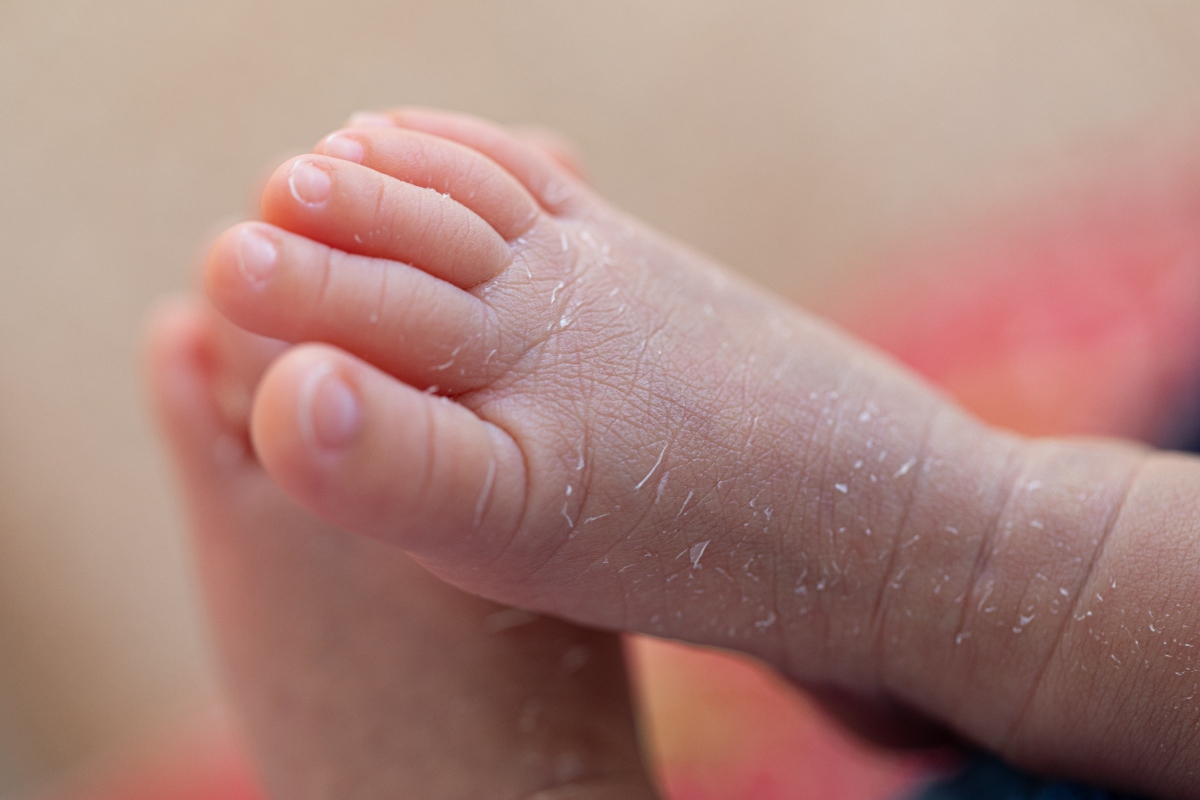 chi soffre di dermatite da contatto
