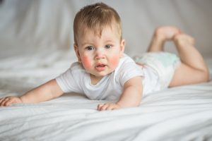 Dermatite atopica : cos’è, chi colpisce, cause, sintomi, diagnosi, trattamenti e rimedi