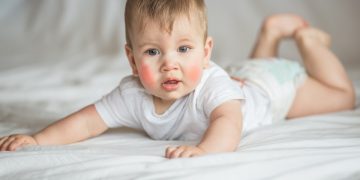 dermatite atopica: cos'è, cause, sintomi e cure