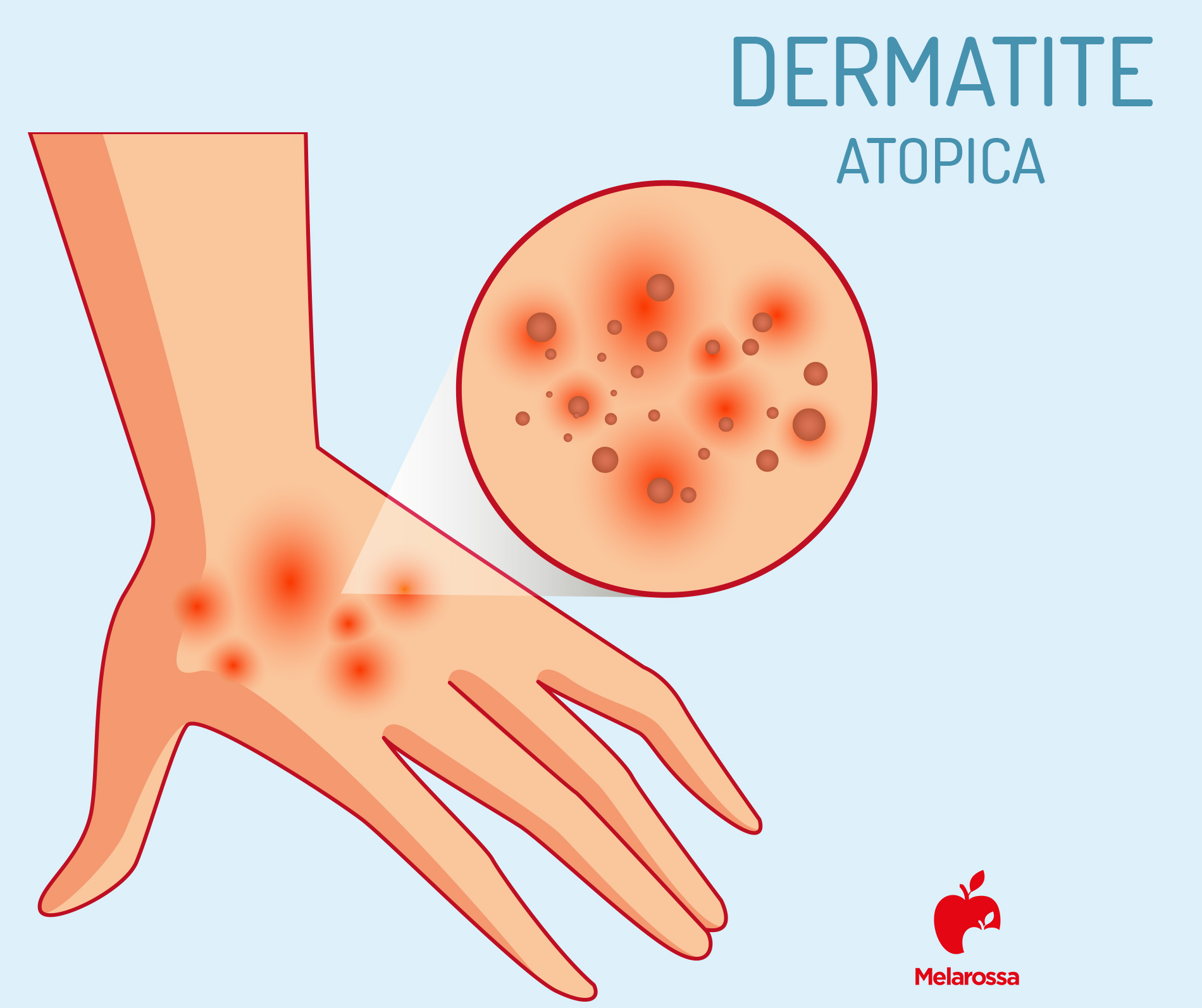 dermatite atopica delle mani