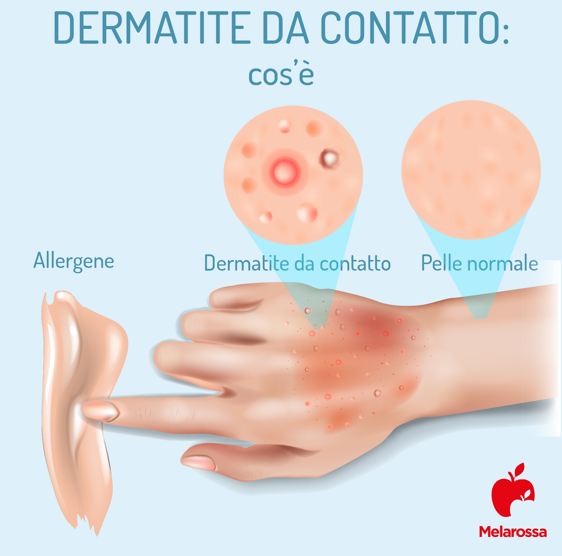 dermatite da contatto: cos'è