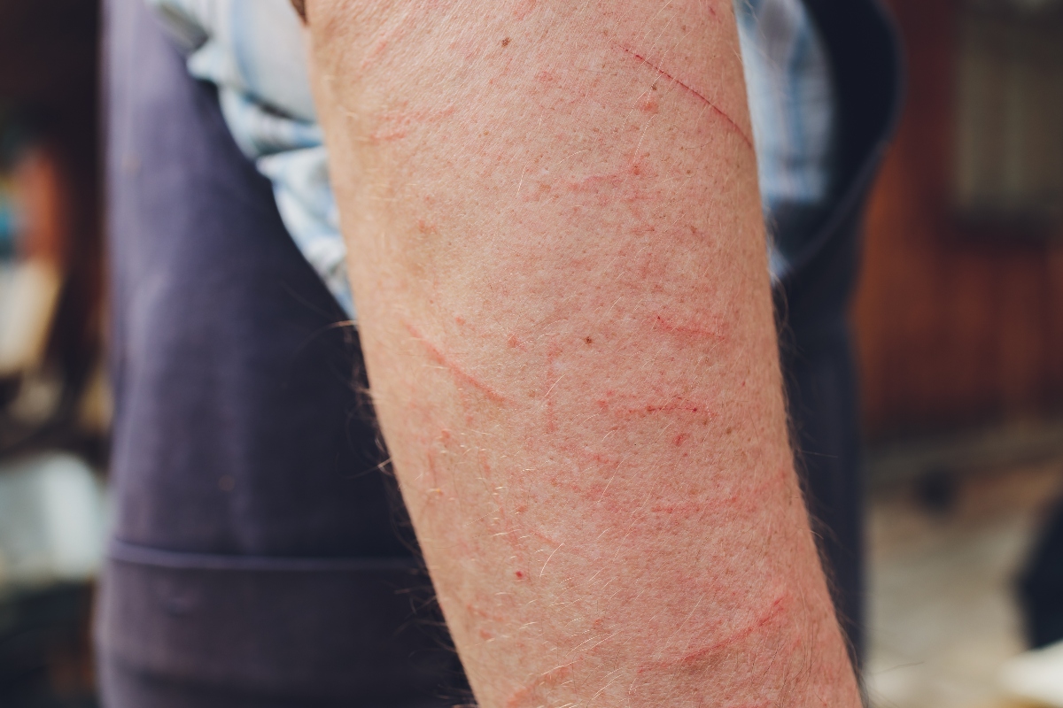 dermatite da contatto: sintomi
