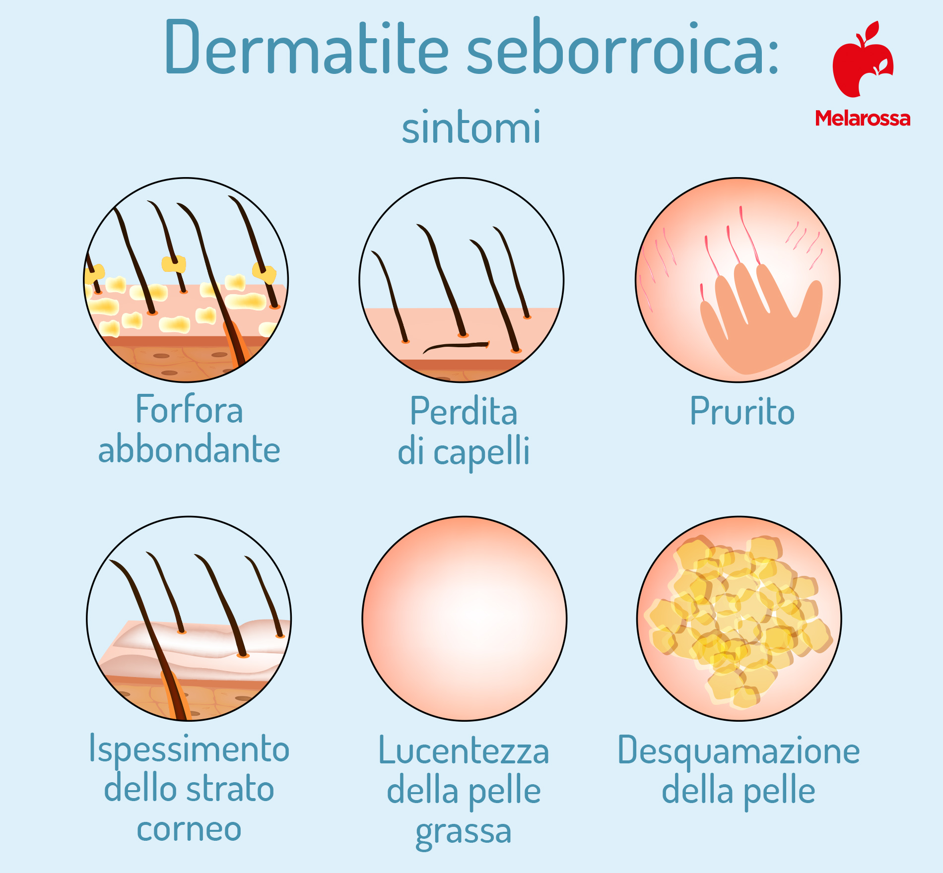 dermatire seborroica: sintomi