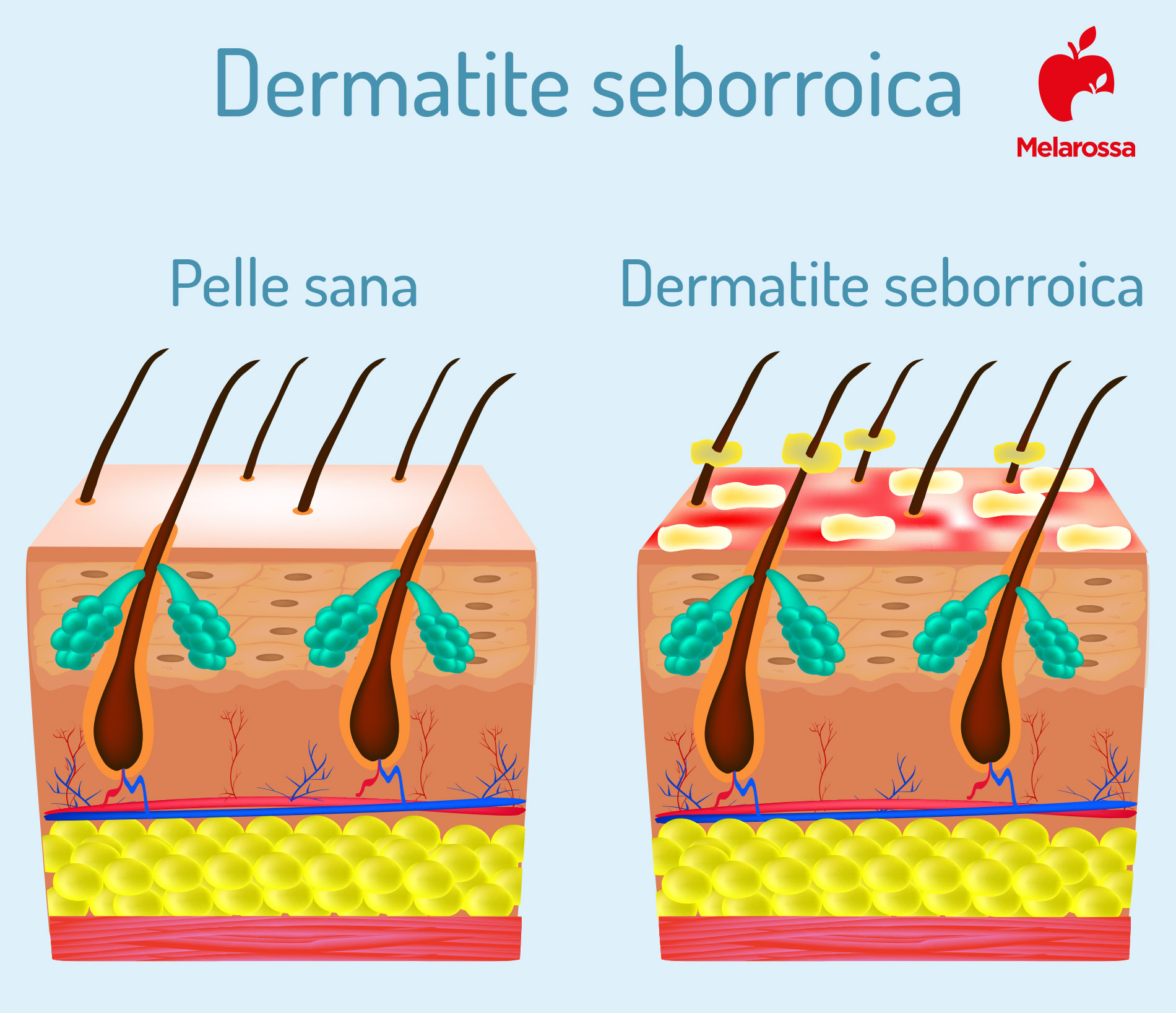 dermatite seborroica: cos'è