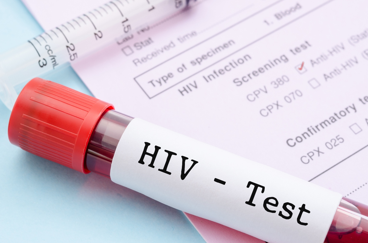 diagnosi AIDS: test HIV 