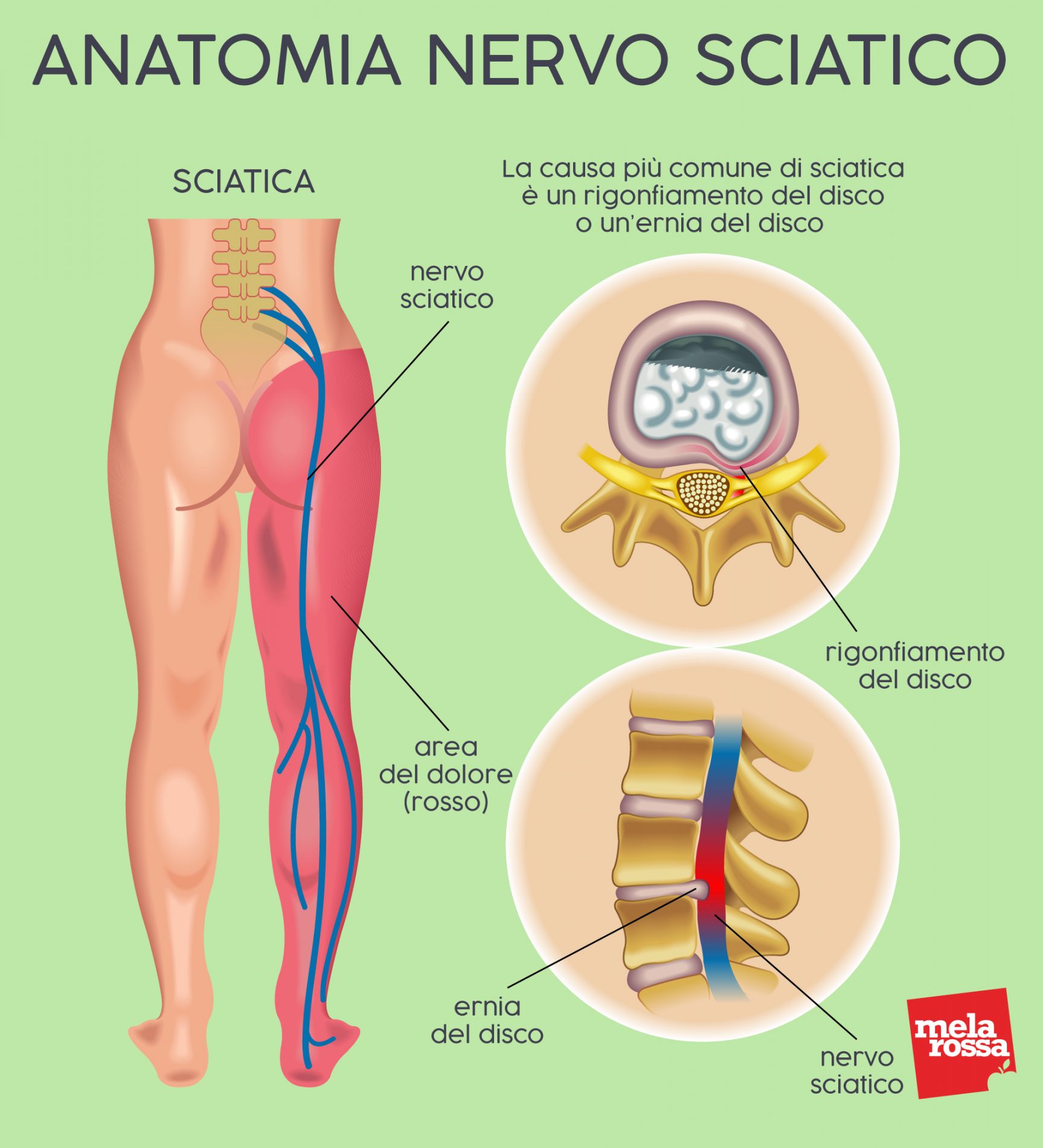 lombosciatalgia: anatomia del nervo sciatico