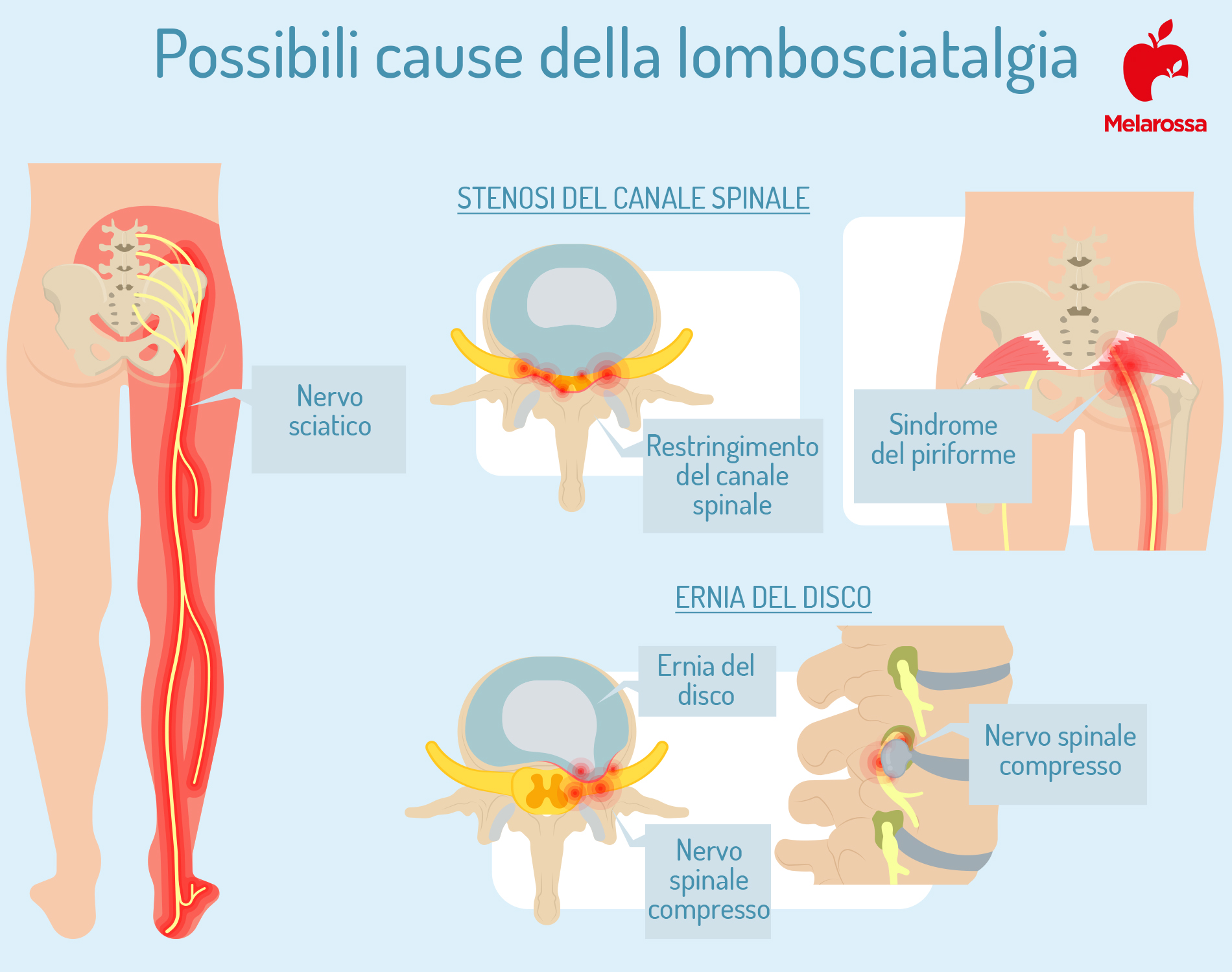 lombosciatalgia: cause