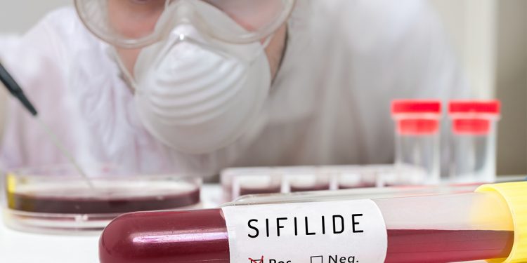 sifilide: cos'è, cause, sintomi e cure