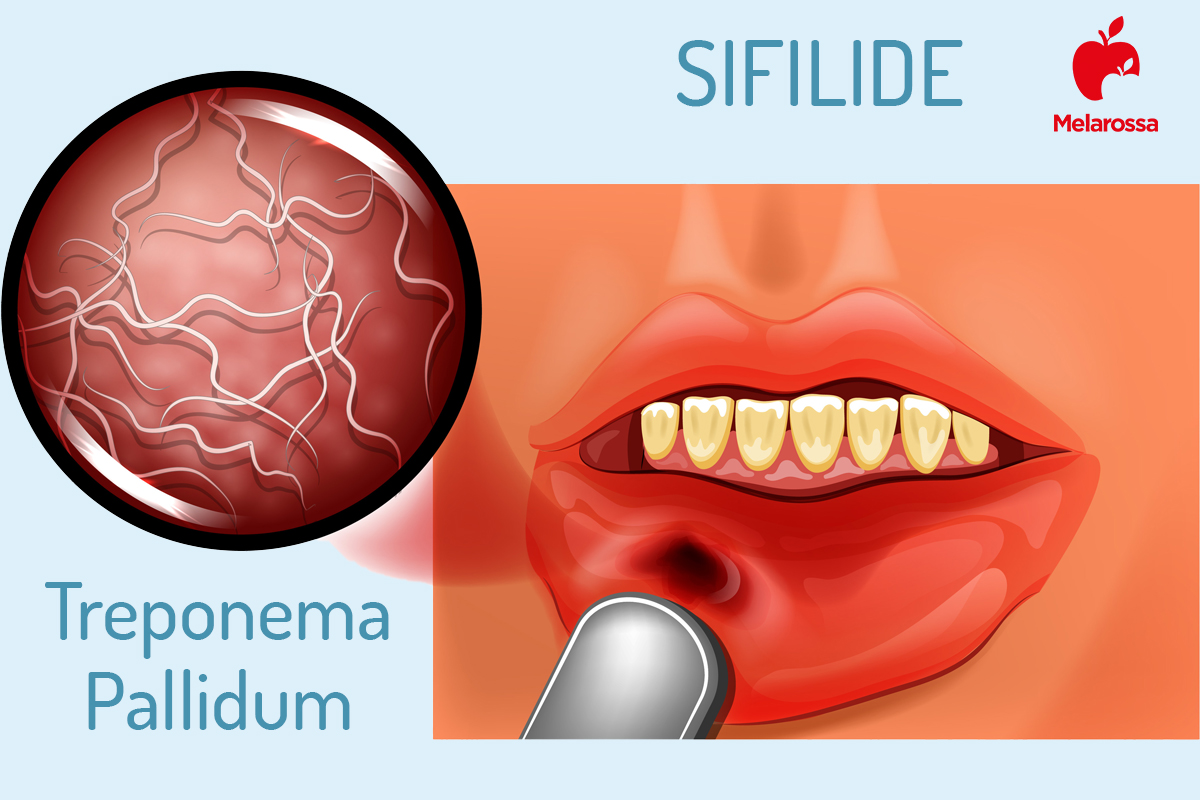 sifilide: sintomi