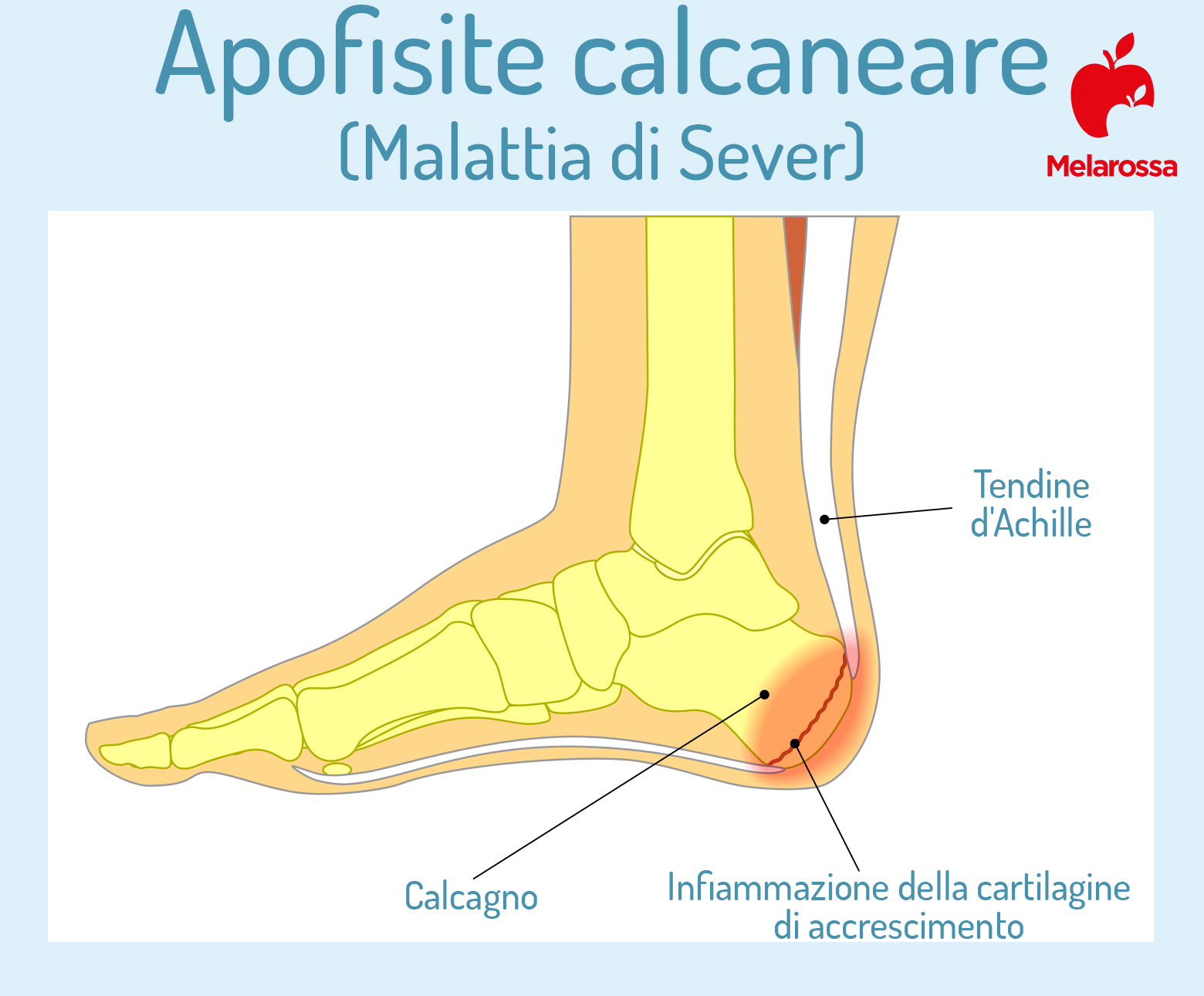 tallonite nei bambini: la malattia di Sever